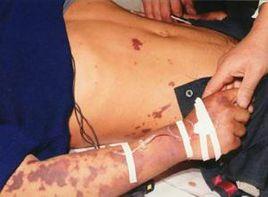 血管內凝血 血管內凝血