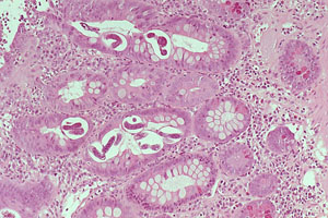 冷球蛋白血症 冷球蛋白血症