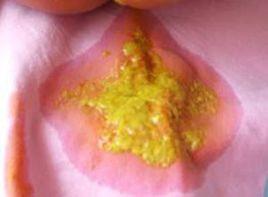 糞便量多 糞便量多