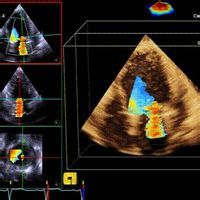 甲亢性高血壓 甲亢性高血壓