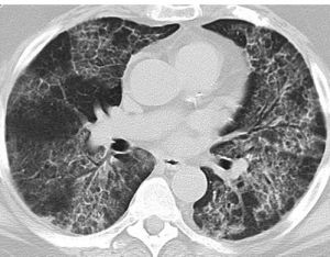 機化性肺炎 機化性肺炎