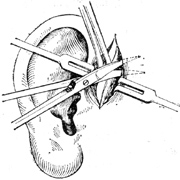 先天性耳前瘺管