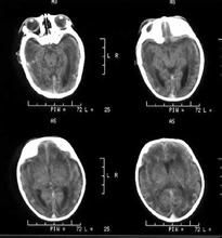 反射性缺氧癲癇