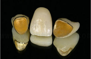 金沉積烤瓷全冠