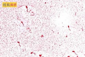 血管活性腸肽瘤