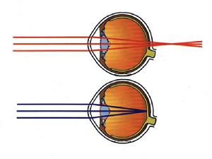 嬰幼兒型內斜視