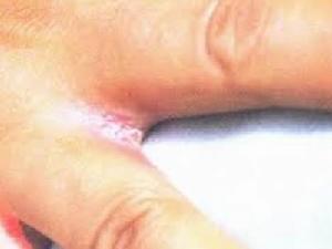 念珠菌引發的病症