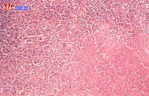 惡性肉芽腫 惡性肉芽腫