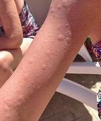 獲得性寒冷性蕁麻疹