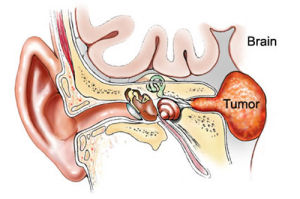聽神經瘤 聽神經瘤