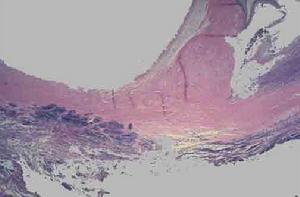 亞急性感染性心內膜炎