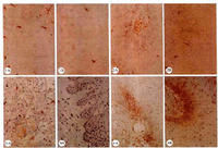 男性尖銳濕疣 男性尖銳濕疣