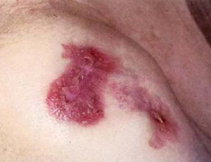 三期梅毒 三期梅毒