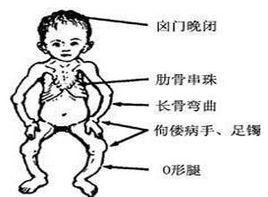 肋骨及胸骨下吸入性凹陷 肋骨及胸骨下吸入性凹陷