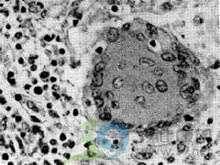 小兒原發性免疫缺陷病