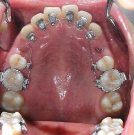 舌側隱形矯正 舌側隱形矯正