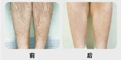 雙冰點脫毛 雙冰點脫毛
