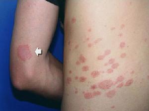 玫瑰糠疹治療
