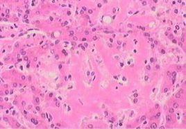 肝臟澱粉樣物質沉積症 肝臟澱粉樣物質沉積症