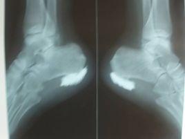 微創增高手術 微創增高手術