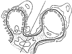 兒童急性腎炎 兒童急性腎炎