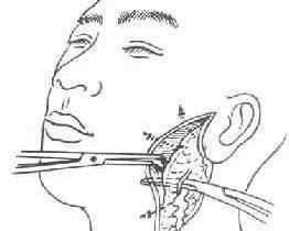 涎腺結石 涎腺結石