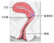 （圖）子宮頸殘端癌