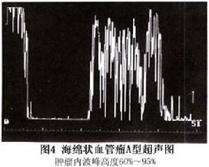 眼眶內海綿狀血管瘤