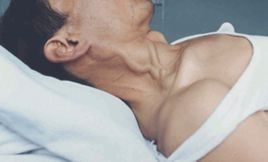 肝頸靜脈返流徵 肝頸靜脈返流徵