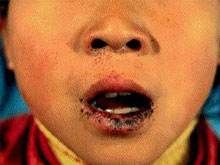 耶格綜合症 耶格綜合症