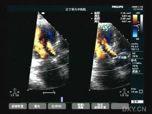 主動脈瓣閉鎖不全