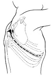 經胸結核病灶清除術