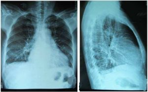 心影增大 心影增大