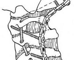 鋼板螺絲釘內固定術