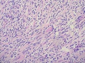 梭形細胞腫瘤 梭形細胞腫瘤