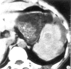 小腸破裂 小腸破裂