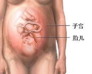 胎膜破裂 胎膜破裂