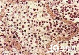 大葉肺炎 大葉肺炎