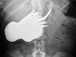 異食癖患者吃掉78件餐具