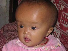 腦積水後遺症 腦積水後遺症