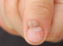 刺瘊，湖南人稱魚痣