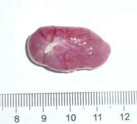 馬尾神經瘤 馬尾神經瘤