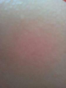 皮膚過敏治療偏方 皮膚過敏治療偏方