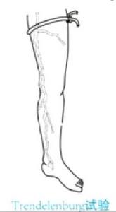 Trendelenburg試驗 Trendelenburg試驗