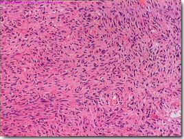 腹膜後惡性腫瘤 腹膜後惡性腫瘤