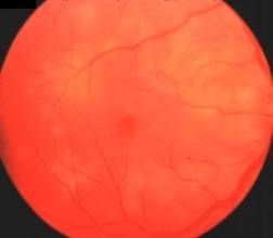 交感性眼炎 交感性眼炎