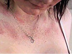 合肥皮膚病過敏醫院