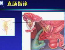 直腸指診取前列腺液