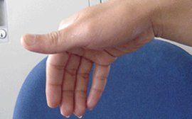 手足多汗症 手足多汗症