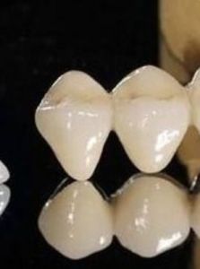 鎳鉻合金烤瓷牙 鎳鉻合金烤瓷牙
